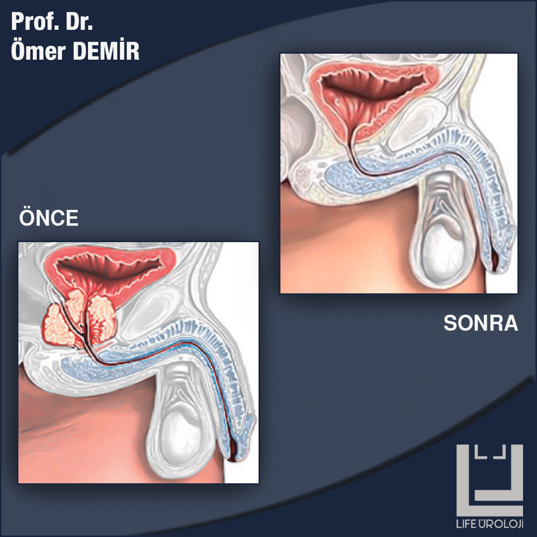 Prostat Ameliyatı İzmir