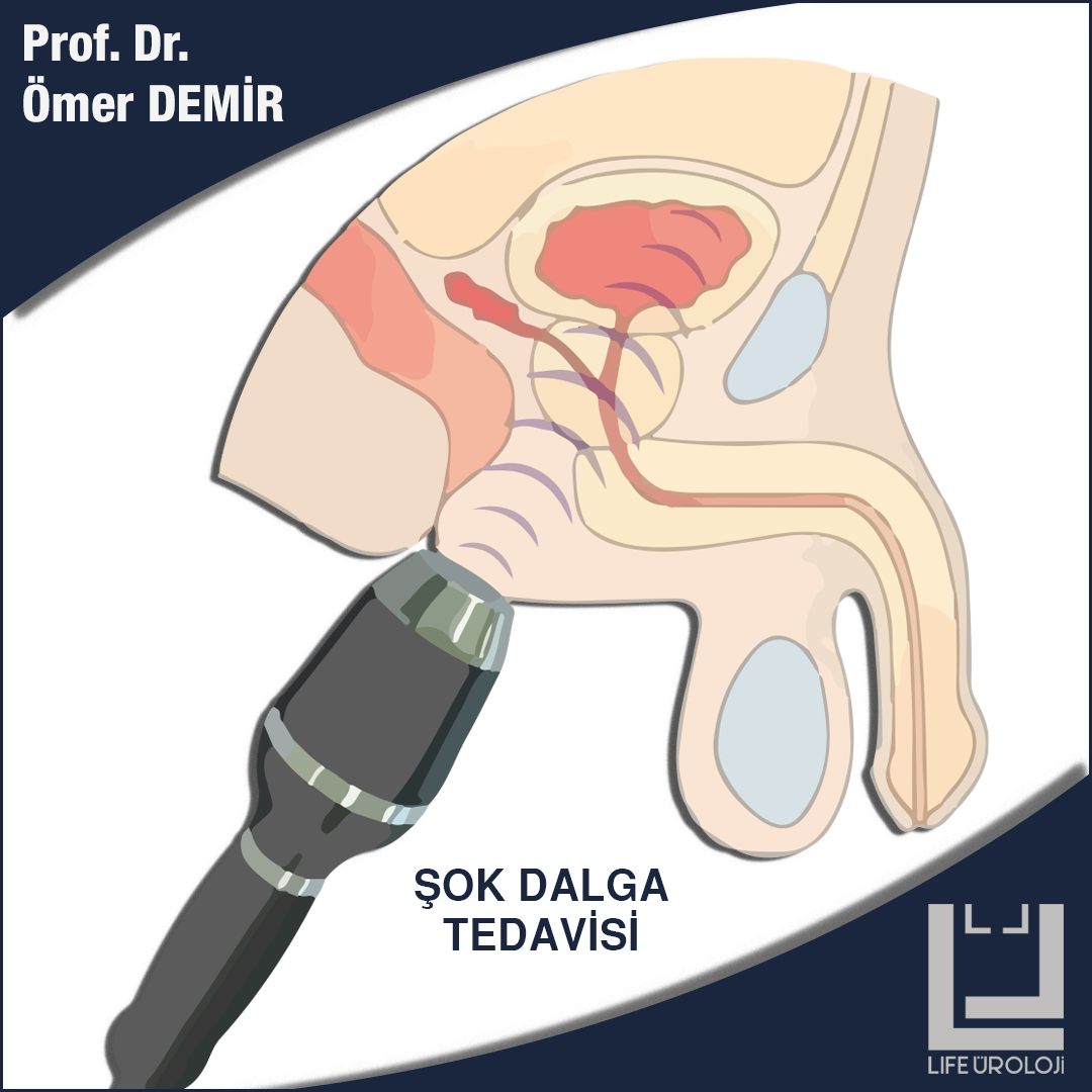 Prostatit Şok Dalga Tedavisi İzmir